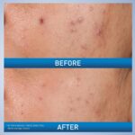 CeraVe Acne Control Gel, Salicylic & Glycolic Acid Face Treatment, 1.35oz/ 39 ml - Image 2